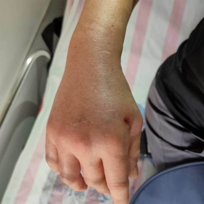 登山客手部遭螫。（民眾提供／李京升苗栗传真）