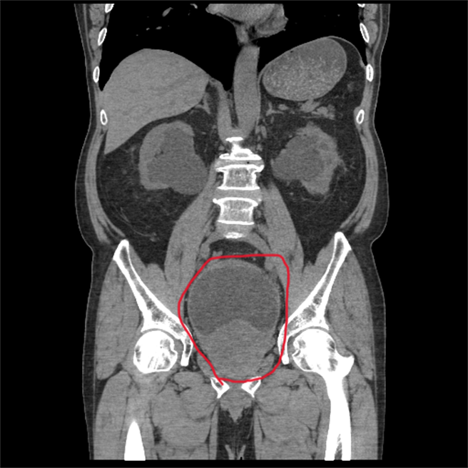 彰化1名60歲的陳男腎臟功能惡化到要洗腎地步，日前他到員榮醫院求診，醫師發現他攝護腺肥大，導致尿液無法排出，膀胱腫脹到常人3倍大。（員榮醫院提供／吳建輝彰化傳真）