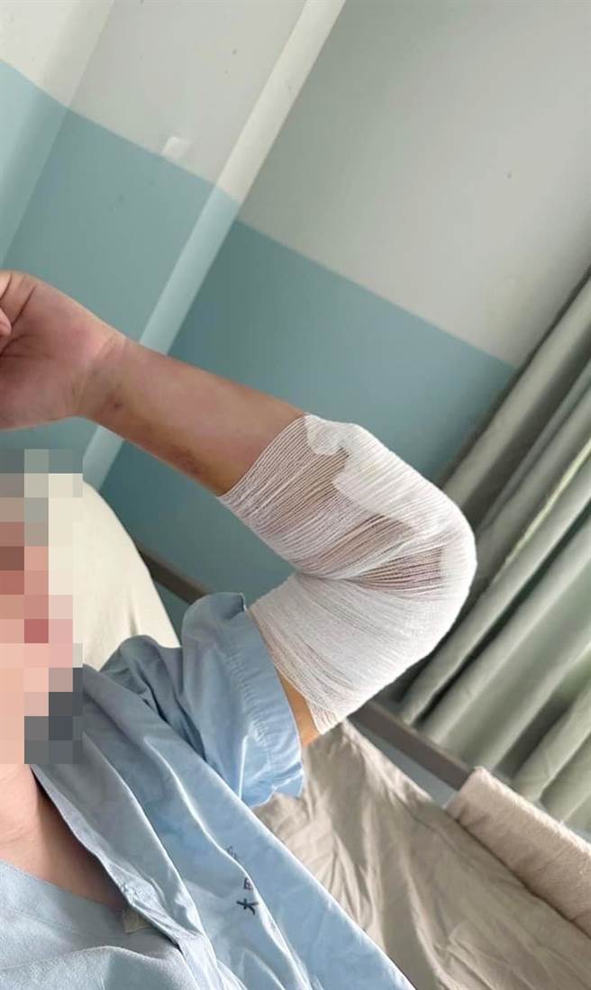 馬來西亞外籍生「小風」過去因車禍造成左手肘粉碎性骨折合併脫臼，手肘韌帶還斷了3條，經外傷骨科和運動醫學醫師跨科合作，固定粉碎性骨折及縫合手肘韌帶後，已恢復正常生活。（大里仁愛醫院提供／潘虹恩台中傳真）