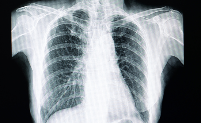 一名女患者的肺结节1颗变10颗，医曝超危险习惯惹祸。（示意图／shutterstock）