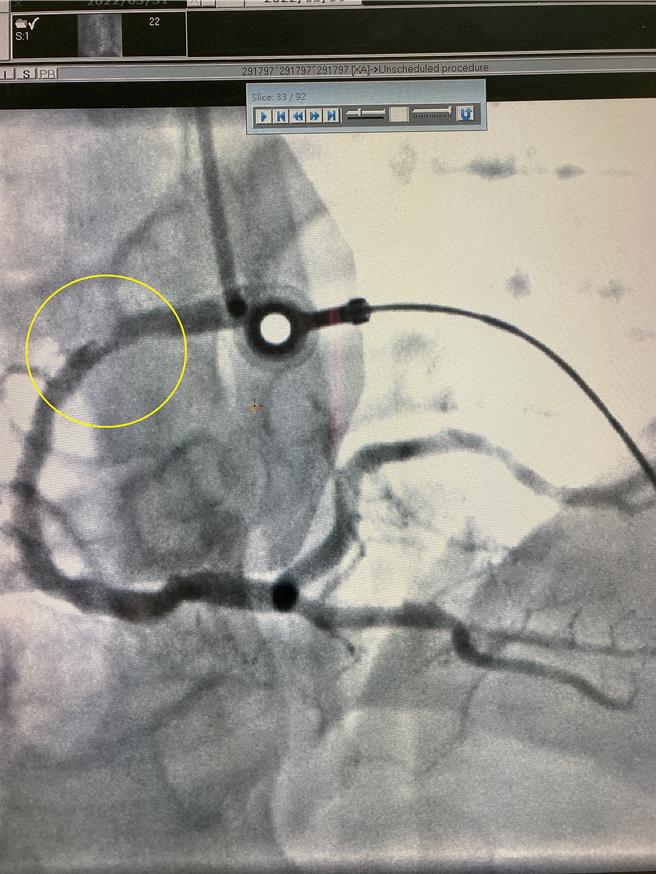 男子日前骑机车上班途中遭蜜蜂螫伤，诱发心肌梗塞造成右侧冠状动脉近端阻塞，紧急进行心导管手术救一命。（南投医院提供／杨静茹南投传真）