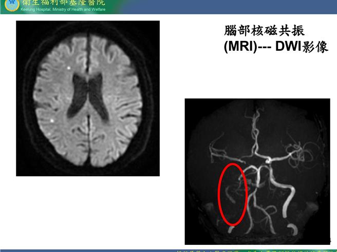 部立基隆医院神经科医师曾冠华表示，老翁虽然仅有轻微无力症状，但从老翁的脑部核磁共振的检查结果，发现老翁右颈动脉的血流讯号完全消失。（部立基隆医院提供／张志康基隆传真）