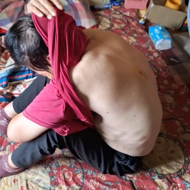 無辜黃姓老婦後背還留有彈珠大小瘀傷。（許逸民攝）