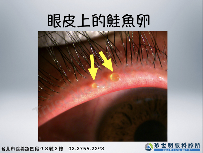 醫師王孟祺表示，女子眼皮冒出的「鮭魚卵」是眼皮上的皮脂腺（瞼板腺）所分泌出來的異常油脂，凝固在腺體的開口處。(圖/ 眼科醫師王孟祺提供)
