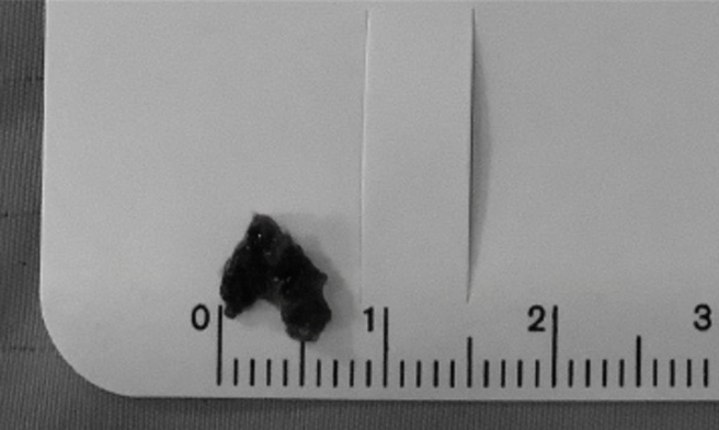 病患血栓块塞住脑血管，以「动脉取栓术」取出。（光田医院提供）
