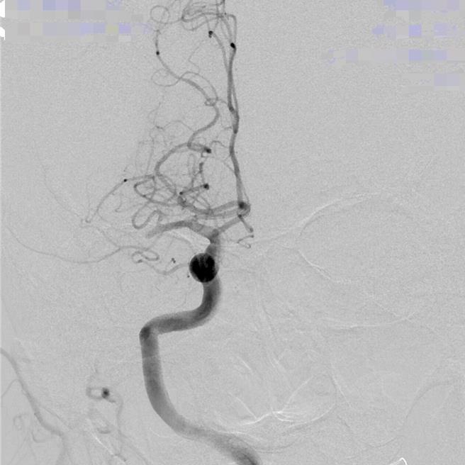 从病患的血管摄影可看出，右半边后面的血管都不见了，即血栓塞住，血流过不去。（光田医院提供）