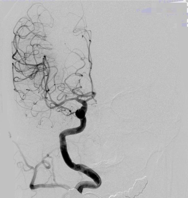 进行颅内动脉取栓治疗后，将血栓取出清除，恢復血流。（光田医院提供）