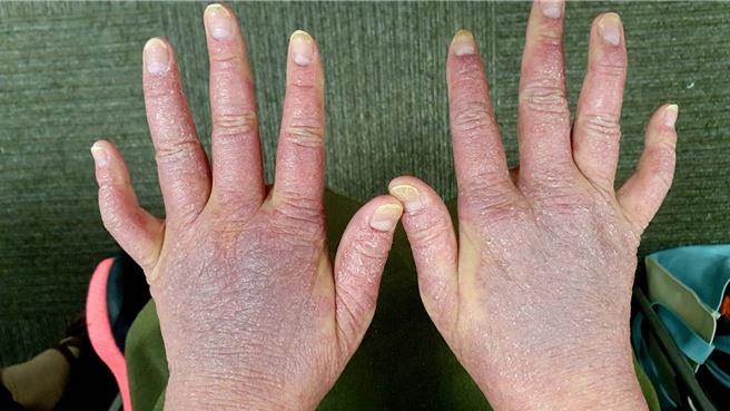 台灣乾癬協會今年針對505位乾癬患者進行問卷調查，其中「曾有被停藥經驗」的病友中，53％在3個月內就會出現乾癬症狀又變嚴重。（王家瑜攝）