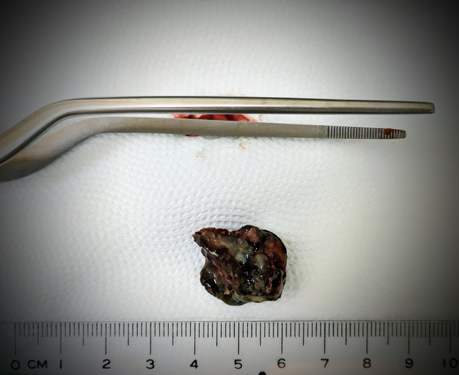 耳鼻喉科医师陈亮宇近日遇上鼻塞超过10年的病患，花费九牛二虎之力才顺利挖出「陈年大鼻屎」，让患者吸到久违的空气。（图／陈亮宇医师提供）