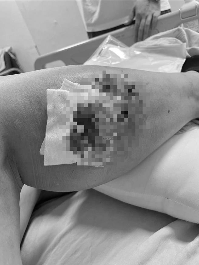 婦人的手腳遭狼犬咬傷，其中右小腿撕裂傷血肉模糊，令人觸目驚心，進行清創手術。（民眾提供／楊靜茹南投傳真）