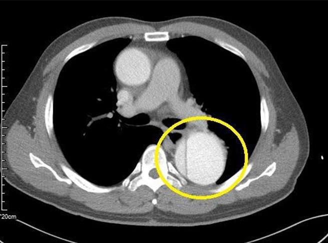 王姓男子降主动脉剥离影像。（丰原医院提供）
