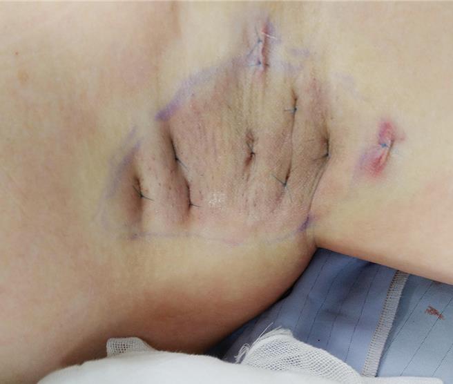 20岁女大学生因严重狐臭腋下发炎化脓，医师评估后过螺旋刀合併抽脂机的微创手术，彻底清除腋下顶浆腺，图为腋下顶浆腺手术及术后皮肤固定保护措。（澄清医院提供／冯惠宜台中传真）