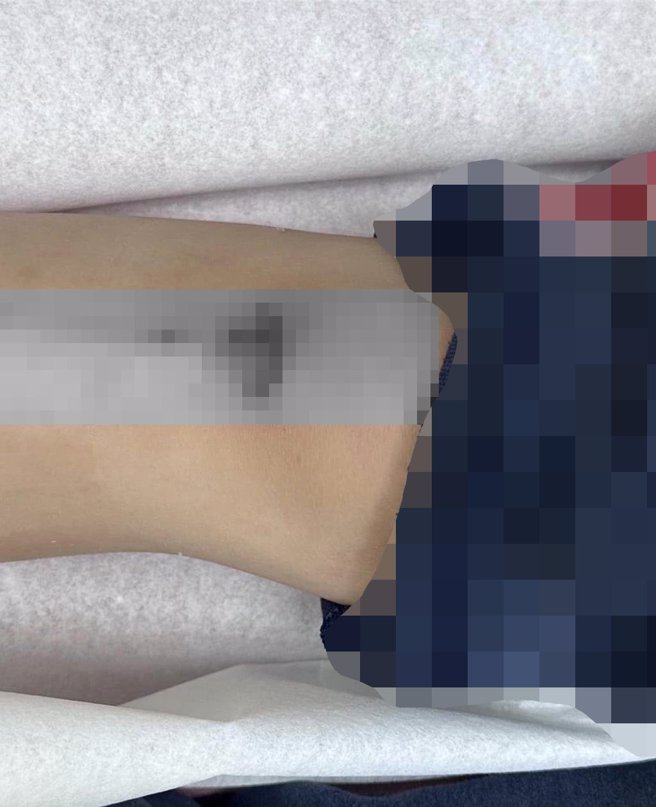 台北市议员许淑华指出，台北敦化国小活动中心因设备老旧没钱整修，导致学童摔倒膝盖撕裂伤，缝了3针。（许淑华提供）