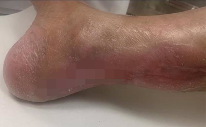 医师安排许妇进行动脉绕道手术，约4个月左右，溃疡伤口癒合成效明显改善。（丰原医院提供）