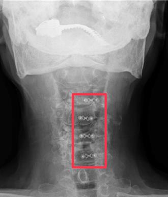 8旬老翁四肢麻木難入眠 醫師靠這手術助他重生
