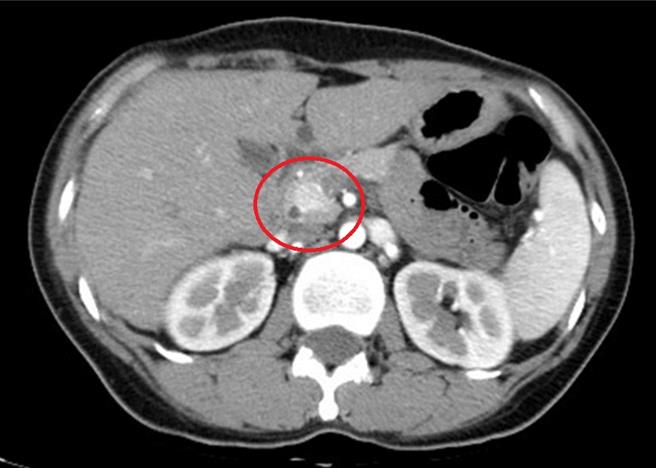 亚洲大学附属医院新陈代谢科医师王子源表示，透过腹部断层扫描察觉胰臟异状。（亚大医院提供／冯惠宜台中传真）