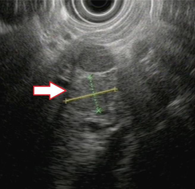 亚洲大学附属医院新陈代谢科医师王子源表示，透过内视镜超音波检查可察觉胰臟异状。（亚大医院提供／冯惠宜台中传真）