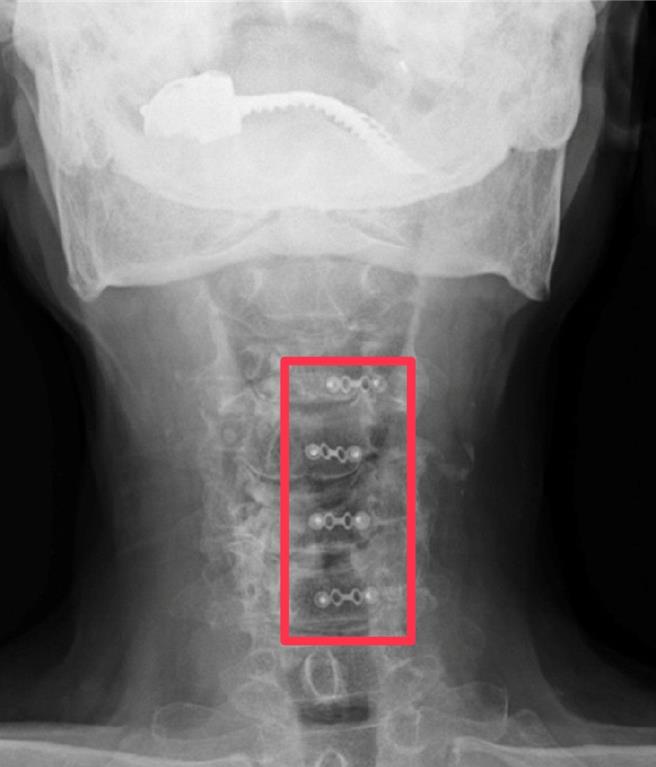 86岁老翁完成椎板成型手术，出血量极小，术后第二天即下床行走，第三天出院，四肢麻木感改善可睡好觉了。（部苗医院提供／李京升苗栗传真）