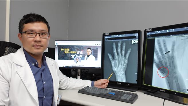 部立苗栗院放射科医师徐庸主任透过X光影像，指出患者右手拇指基底关节已明显退化和变形，此处即为本次疼痛治疗目标。（部苗提供／谢明俊苗栗传真）