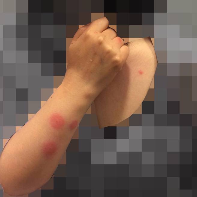 被床虱咬到奇痒无比，肿包从1元硬币到比50圆硬币大小都有可能，呈红色、粉红色或暗红色，通常排成线状，一次吸3个包。(皮肤科蔡逸姗医师FB提供)