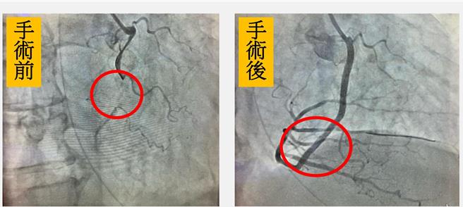 60岁林姓男子有心臟衰竭、慢性肾衰竭和糖尿病等多种慢性疾病，日前因新冠重症送急诊，发现右冠状动脉严重堵塞（左图），经皮冠状动脉治疗打通（右图），治疗3个礼拜终于好转出院。（大里仁爱医院提供／潘虹恩台中传真）