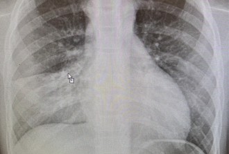 9歲女童染黴漿菌「狂咳又發燒」 醫照X光驚：肺白掉了