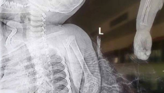 惊悚！1岁半男婴手伸藏獒狗笼   遭「一口扯断右臂」花6小时接回