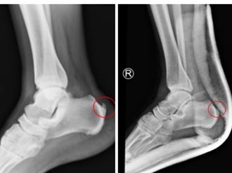 他收竹筍足跟竟骨刺發作痛倒地 醫指這4大族群好發