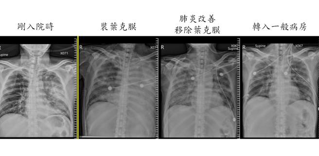 徐先生從入院肺部一片白的狀況，到出院時已順利恢復正常。（大千醫院提供／李京昇苗栗傳真）