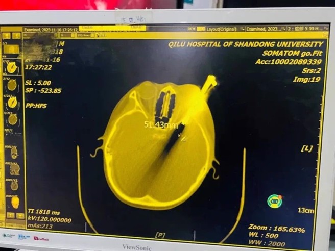 男童的颅内电脑断层显影。（图／取自青岛半岛全媒体）