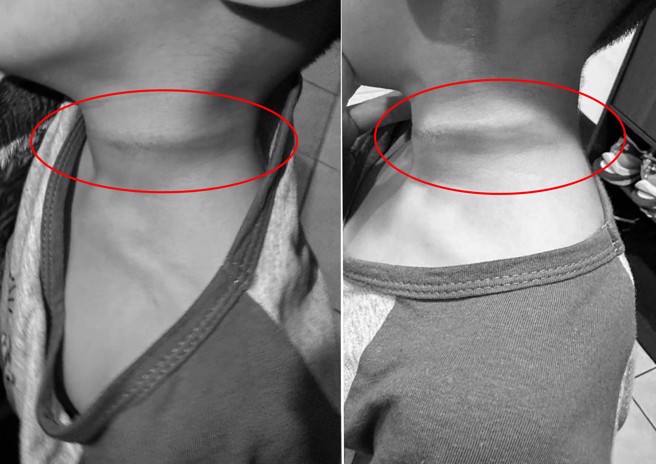 男童在幼稚園玩拔拔河被繩子勒脖，家長指控老師10多秒後才發現。（圖／翻攝爆料公社二社）