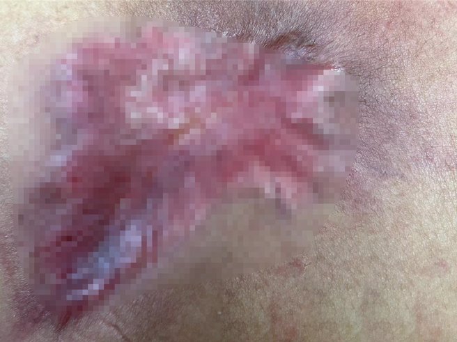 蔡女士因自己独居，家中经济情况不佳，院方主动协助派居家护理师每天到蔡女士住家帮她换药，出院后经过近3个月，伤口才完全癒合。（彰化医院提供／吴建辉彰化传真）