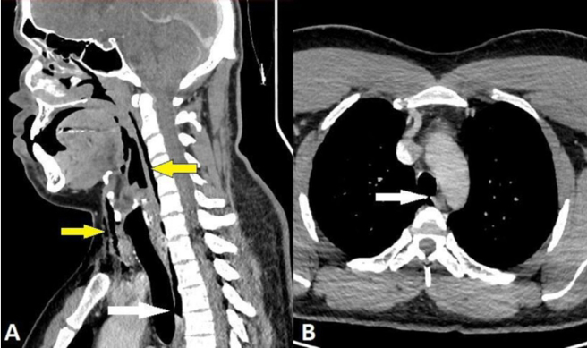 醫院檢查顯示男子的氣管出現一道撕裂傷。（圖／翻攝自BMJ官網）