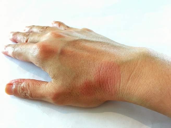 紅斑性狼瘡除了臉部外，全身各部位都會出現圓盤狀紅斑。(示意圖／shutterstock)