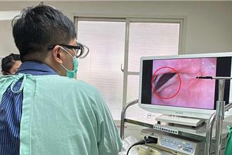 新竹女切除甲狀腺後聲音沙啞、易嗆咳 一查竟是這問題