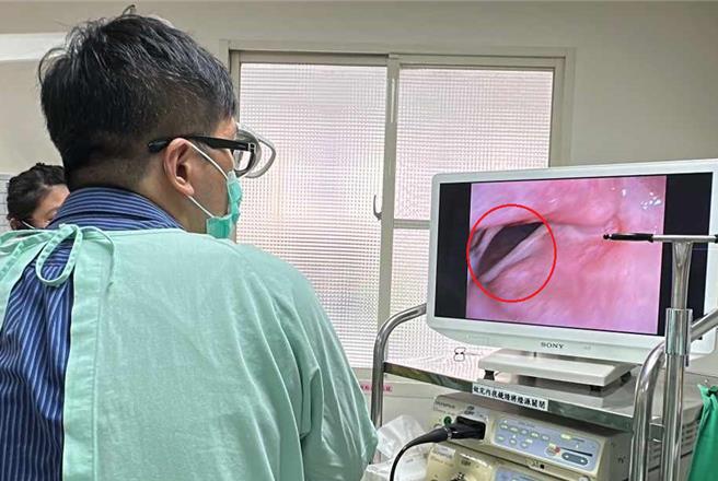 新竹台大分院耳鼻喉部医师李自祥说明，病人因声带麻痹闭合不全（红圈所示），经微创声带玻尿酸注射手术治疗后，声带可闭合，沙哑明显改善且进食不会呛咳。（新竹台大提供／王惠慧新竹传真）