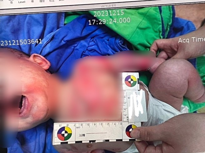 男嬰家長在網路控訴，新竹市私人托嬰中心托育人員照顧不當，造成她3個月的兒子全身50%大面積燙傷。（翻攝爆料公社）