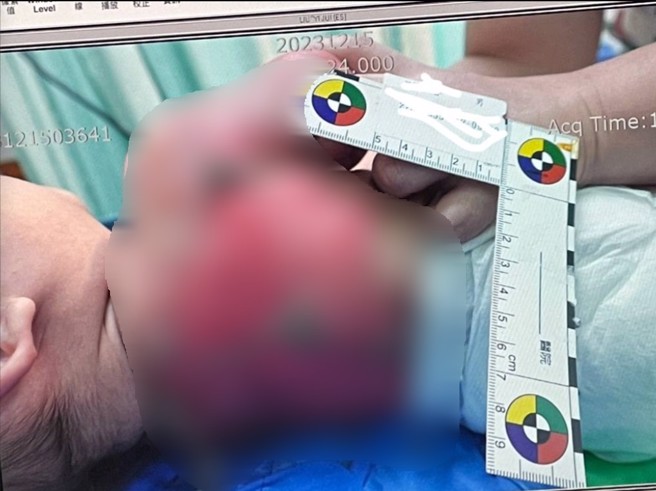 男嬰家長在網路控訴，新竹市私人托嬰中心托育人員照顧不當，造成她3個月的兒子全身50%大面積燙傷。（翻攝爆料公社）