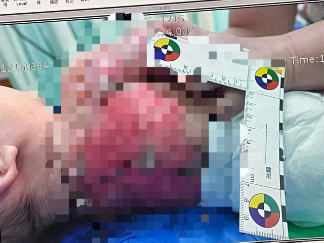 新竹市某私人托嬰中心遭投訴，疑似因托育人員照顧不當，3個月大男嬰遭熱水淋身，目測全身超過50％二度燒燙傷。（民眾提供）