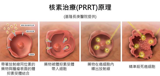 核素治疗(PRRT)。图长庚提供