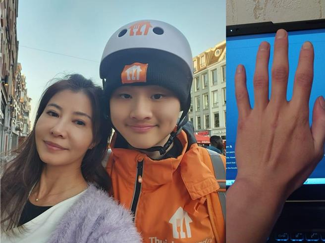 岳庭的儿子在荷兰的寒冬低温中骑单车打工送餐，手冻伤。（摘自岳庭脸书）