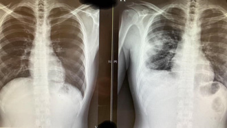 染流感併发肺塌陷 年轻人肺叶全扁 差点「断气」 