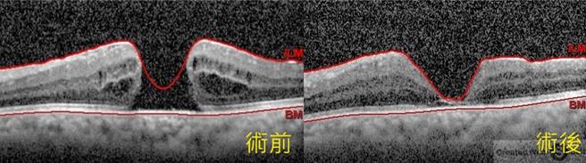 6旬男子到长安医院检查发现黄斑部裂孔，经微创手术治疗后，眼球光学断层扫描照片显示，黄斑部裂孔已经成功癒合。（长安医院提供／冯惠宜台中传真）