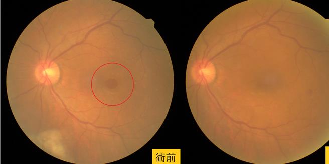 眼底摄影照显示，原先黄斑部的裂孔（中央的橘红色圆形病灶）已经癒合、消失。（长安医院提供／冯惠宜台中传真）