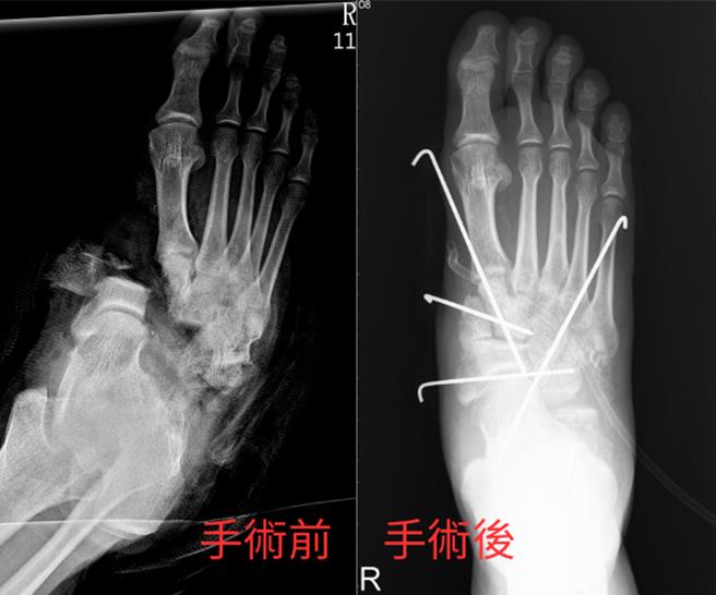 宜兰31岁吴姓男子因重大车祸导致右脚掌遭撞击骨肉全散，仅皮肤相连，送至医院急救时情况惨不忍睹。（罗东博爱医院提供／吴佩蓉宜兰传真）