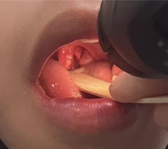 發高燒誤以為流感！男童腳底紅疹、喉嚨潰瘍 手足口病惹禍