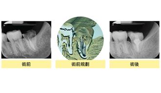 大臼齒斷了以為沒救 醫師妙手回春自體植牙