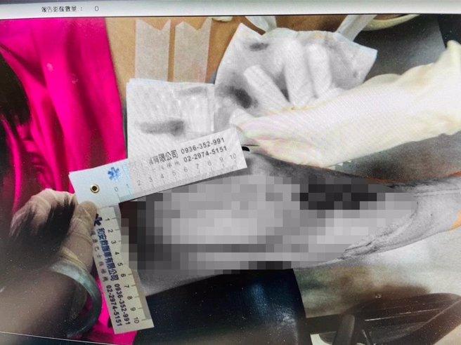 4岁董小妹意外踩入破损水沟盖，造成右大腿及小腿长达20公分深度撕裂伤。（彭佳芸办公室提供／刘玮晴新北传真）