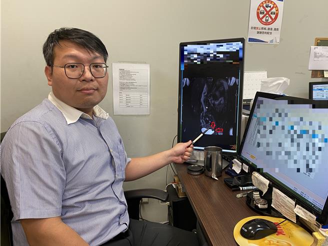 台中市1名50多岁妇人，因腰痛频尿到台中长安医院求诊，在膀胱黏膜下方发现一颗3公分肿瘤，透过病理报告证实为罕见「良性膀胱平滑肌瘤」。（长安医院提供／王煌忠台中传真）