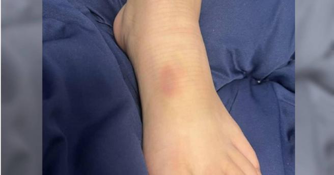 網友透露，女兒被超商外面供人座的鐵椅子意外砸到腳，導致腳正面被砸到瘀青。（圖／爆料公社）